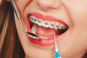 Specialised Dentistry Braces
