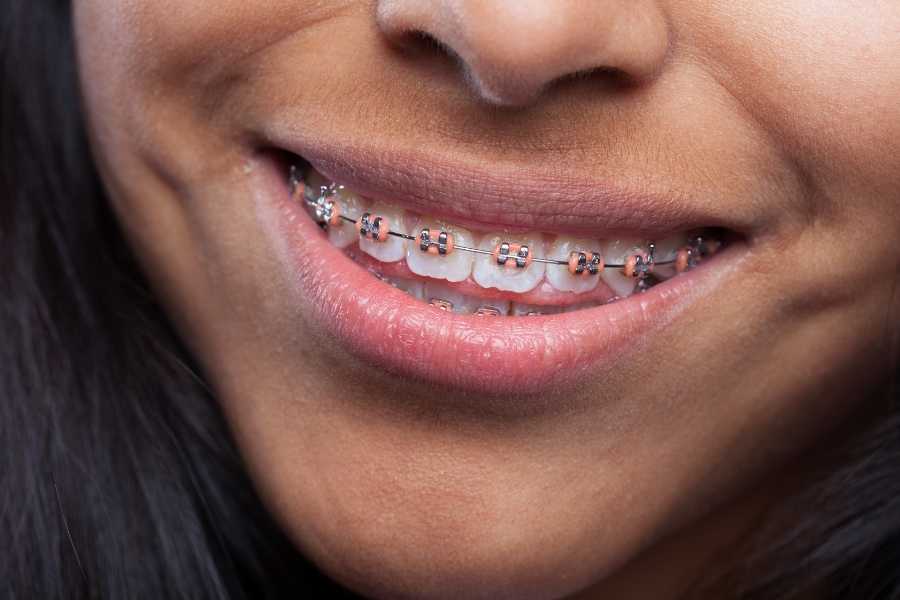 Adult Braces