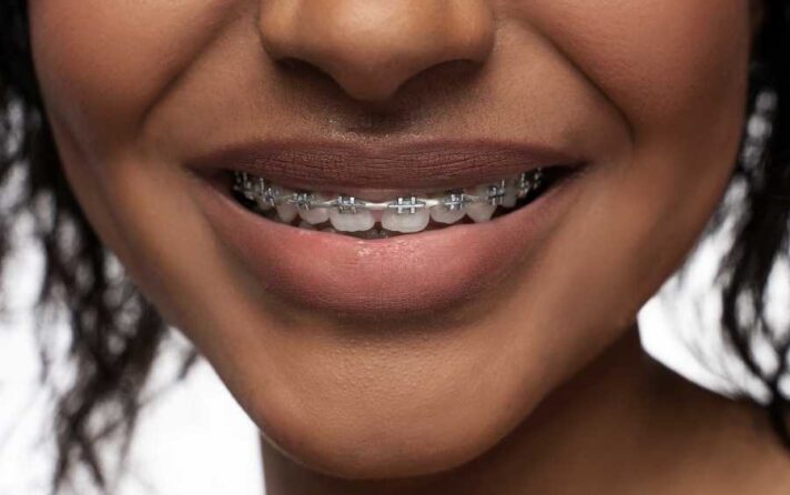 Braces