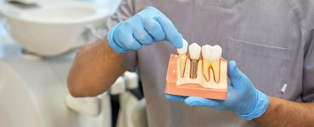 Dental Implants