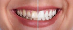 Professional Teeth Whitening