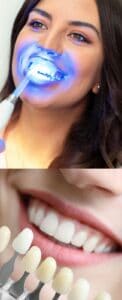 Professional Teeth Whitening (650 x 1600 px)